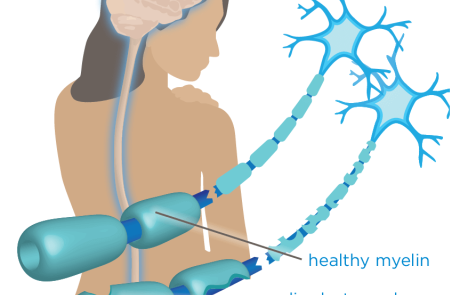 Blog Main Image - 2D Multiple Sclerosis MS Myelin Healthy v Damaged