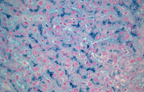 Blog Scientific Liver Human Iron Storage Disease