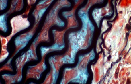 Blog Scientific Proteoglycans Excessive Deposition Vascular Disease