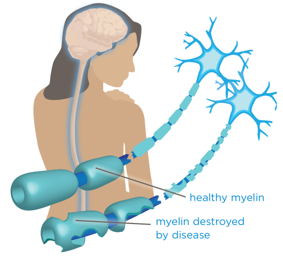 Blog Main Image - 2D Multiple Sclerosis MS Myelin Healthy v Damaged