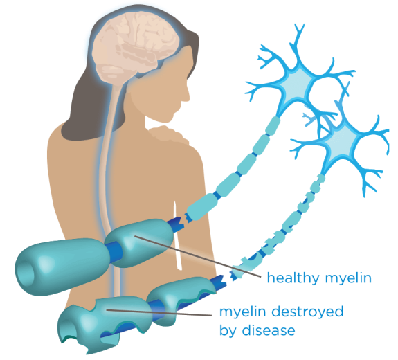 Blog 2D MS Myelin Healthy vs Damaged