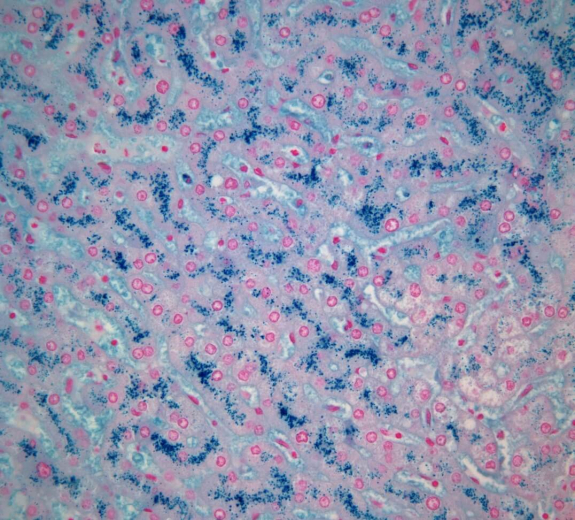 Blog Scientific Liver Human Iron Storage Disease