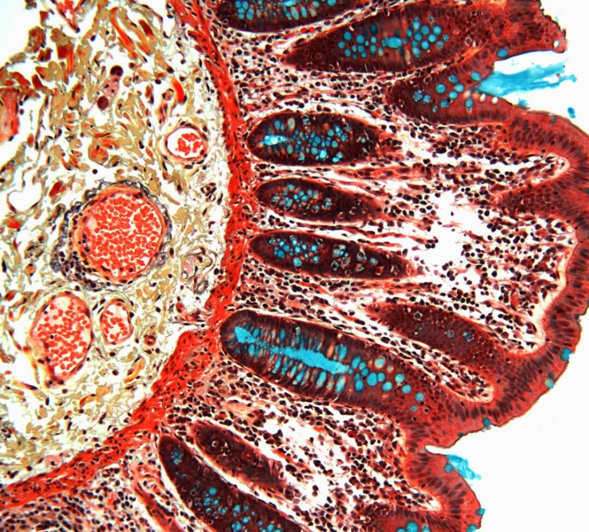 New Biorepository Studies Celiac Disease | Benaroya Research Institute