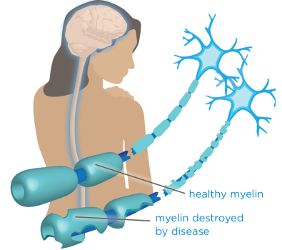 Blog 2D MS Myelin Healthy vs Damaged